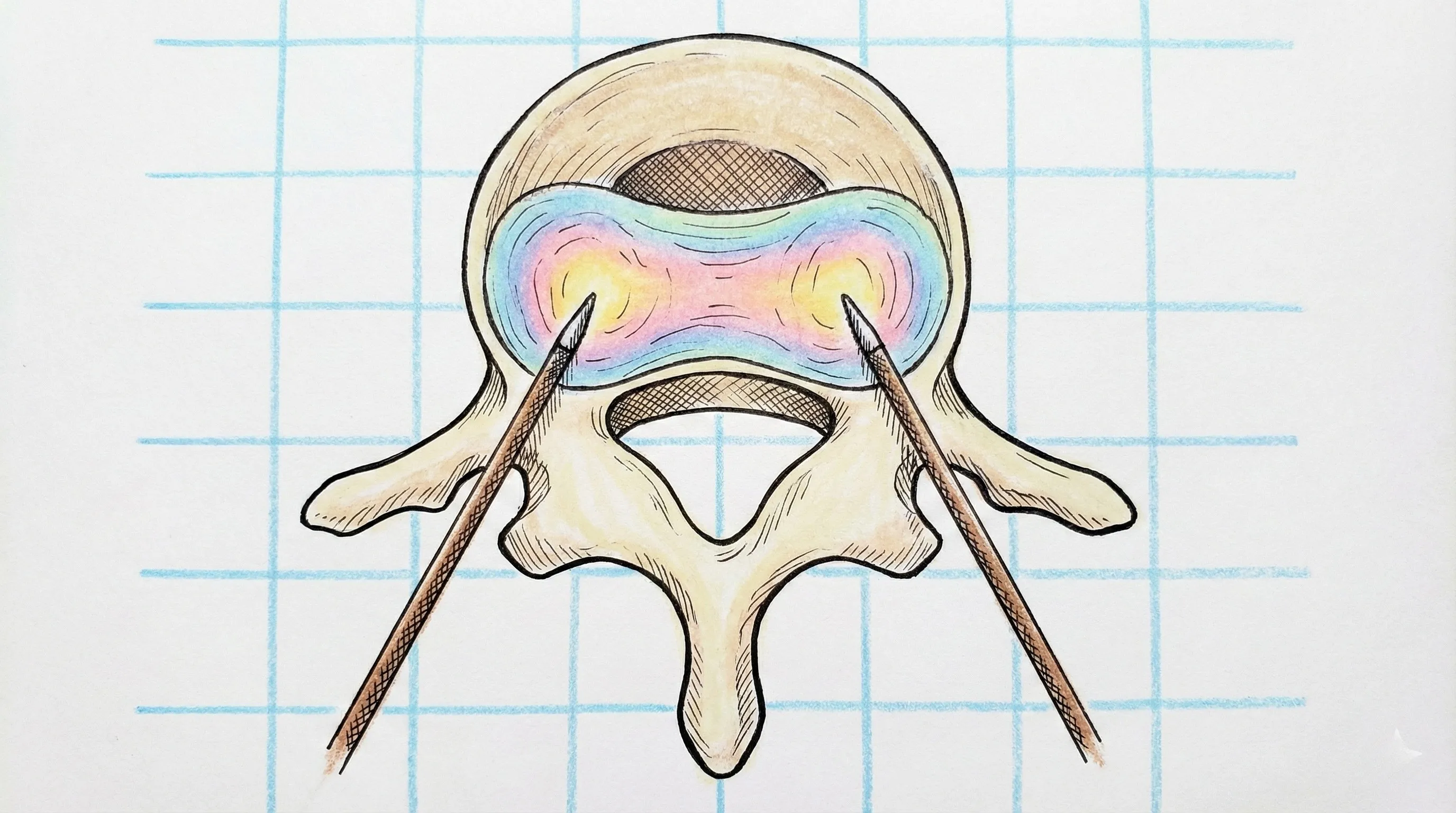 ⚡ Biacuplastia Discal Lombar por Radiofrequência Bipolar
